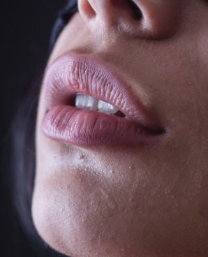 Modelowanie ust – kwas hialuronowy